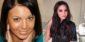 Оксана Самойлова фото до и после пластики